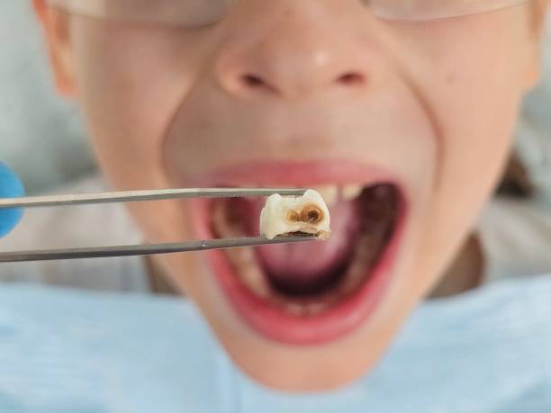 Best Pediatric Emergency Dentist in Hewitt, TX
